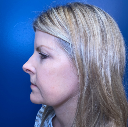 Facial Fat Grafting Before & After Patient #15046