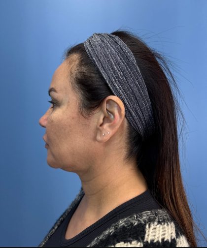 Blepharoplasty Before & After Patient #15034