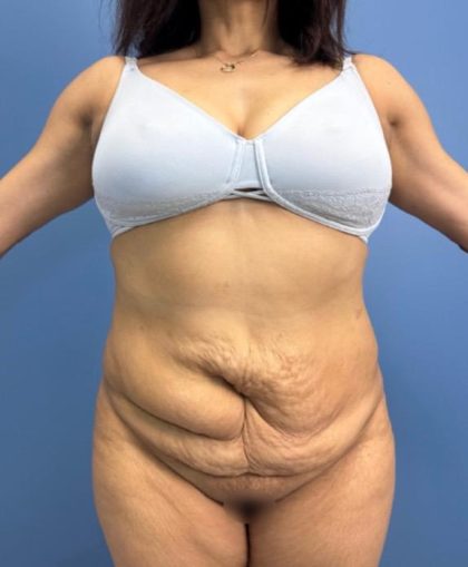 Lower Body Lift Before & After Patient #15802