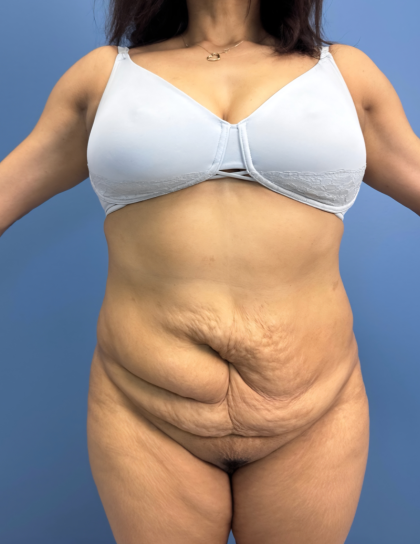 Lower Body Lift Before & After Patient #15802