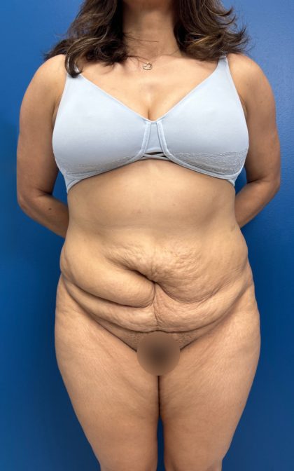 Lower Body Lift Before & After Patient #15802