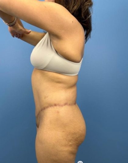 Lower Body Lift Before & After Patient #15802