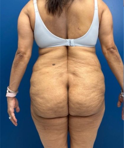Lower Body Lift Before & After Patient #15802