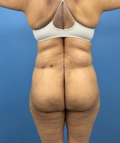 Lower Body Lift Before & After Patient #15802