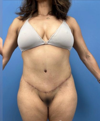 Lower Body Lift Before & After Patient #15802