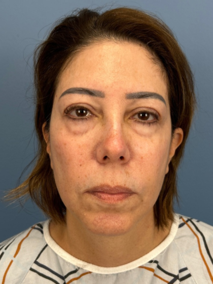 Facial Fat Grafting Before & After Patient #15857