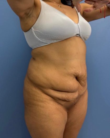 Lower Body Lift Before & After Patient #15802