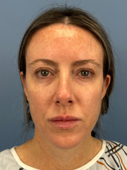 Browlift Before & After Patient #15868