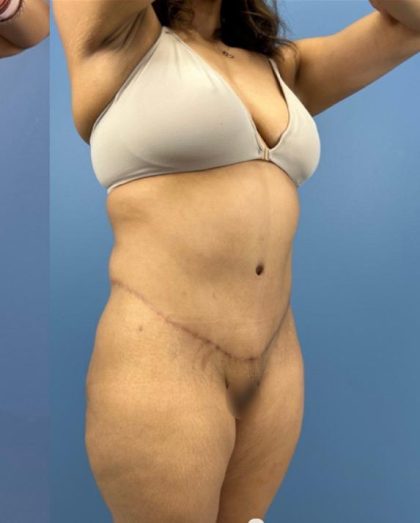 Lower Body Lift Before & After Patient #15802