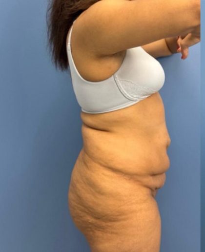 Lower Body Lift Before & After Patient #15802