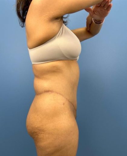 Lower Body Lift Before & After Patient #15802