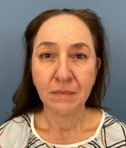 Facial Fat Grafting Before & After Patient #15978