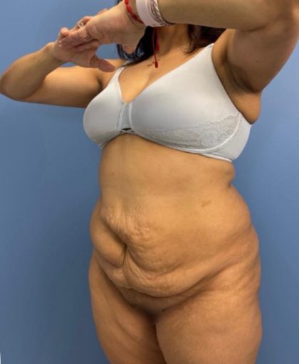 Lower Body Lift Before & After Patient #15802