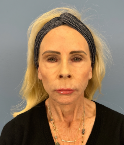 Facial Fat Grafting Before & After Patient #15993