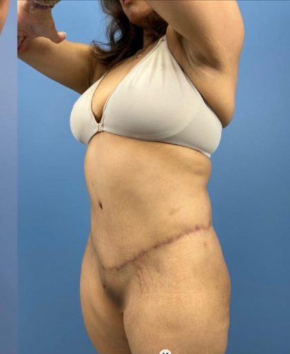 Lower Body Lift Before & After Patient #15802