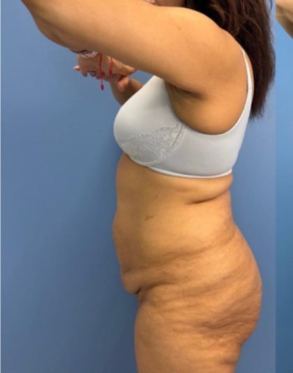 Lower Body Lift Before & After Patient #15802