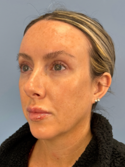 Blepharoplasty Before & After Patient #15869