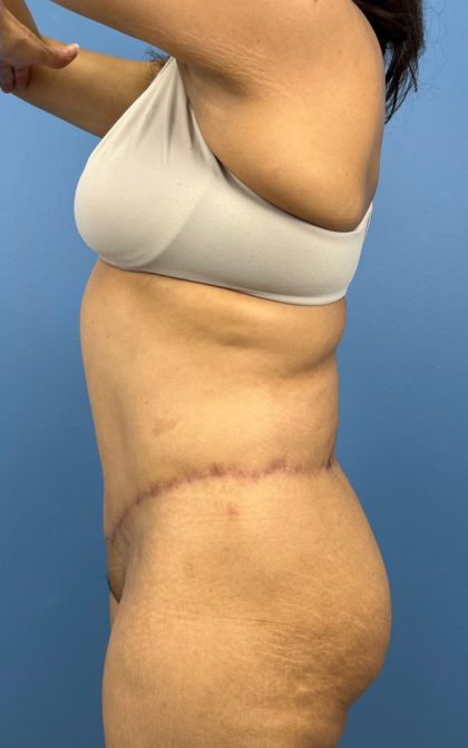 Lower Body Lift Before & After Patient #15802