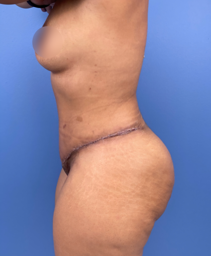 Tummy Tuck Before & After Patient #15911