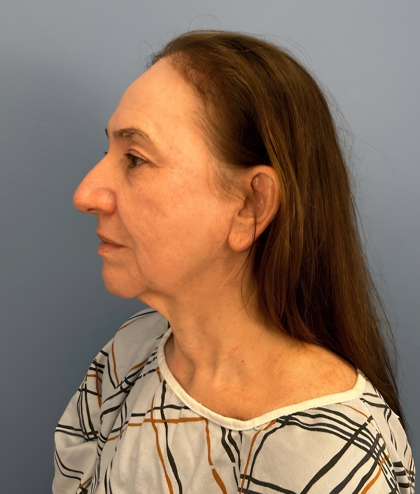 Facial Fat Grafting Before & After Patient #15978
