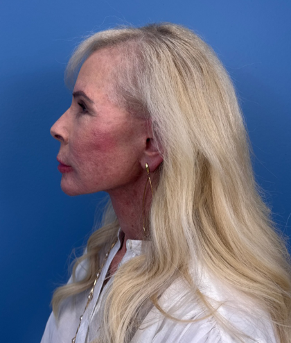 Facial Fat Grafting Before & After Patient #15993