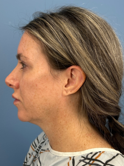 Blepharoplasty Before & After Patient #15869