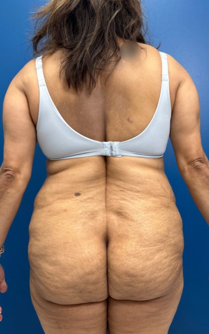 Lower Body Lift Before & After Patient #15802