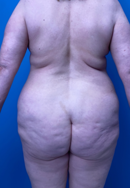 Lower Body Lift Before & After Patient #15924