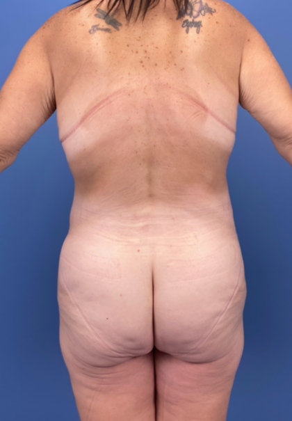Lower Body Lift Before & After Patient #15939