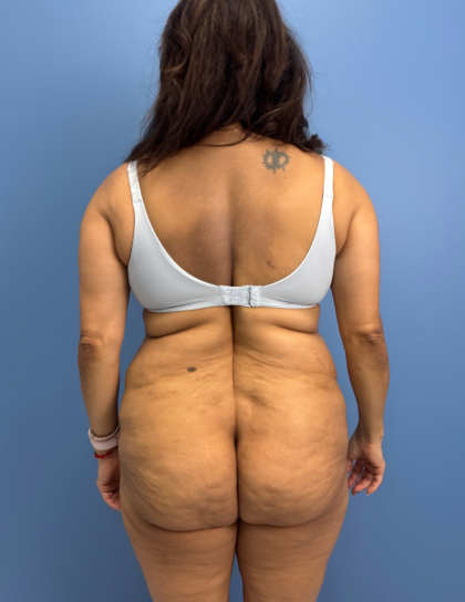 Lower Body Lift Before & After Patient #15802