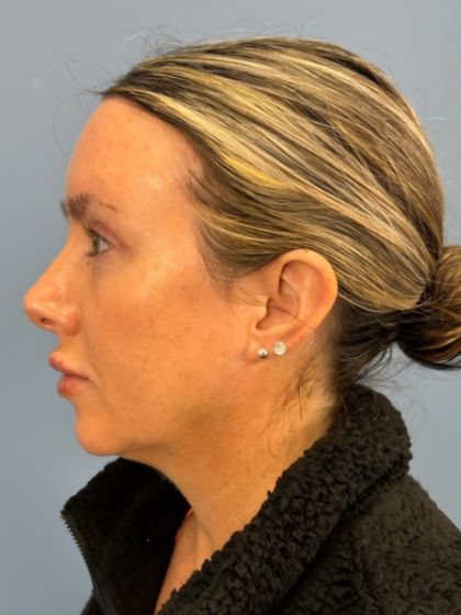 Blepharoplasty Before & After Patient #15869
