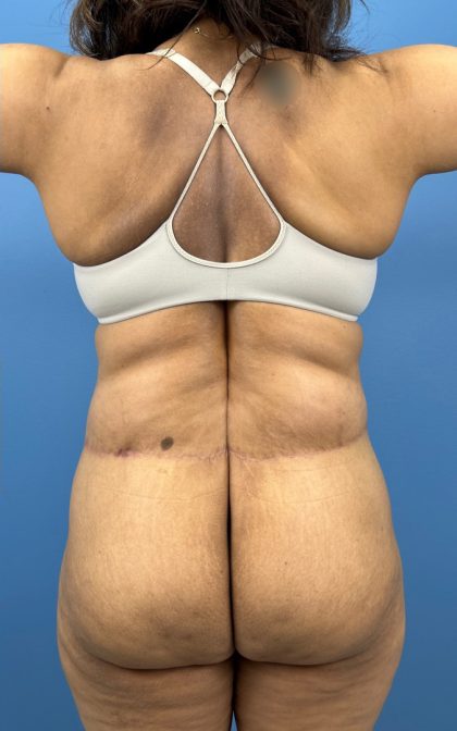 Lower Body Lift Before & After Patient #15802
