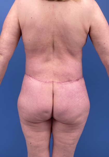 Lower Body Lift Before & After Patient #15924