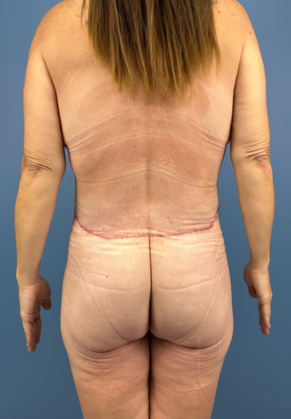 Lower Body Lift Before & After Patient #15939