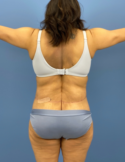Lower Body Lift Before & After Patient #15802