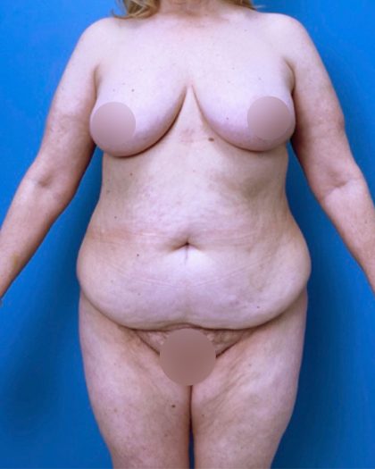 Surgery After Massive Weight Loss Before & After Patient #15924