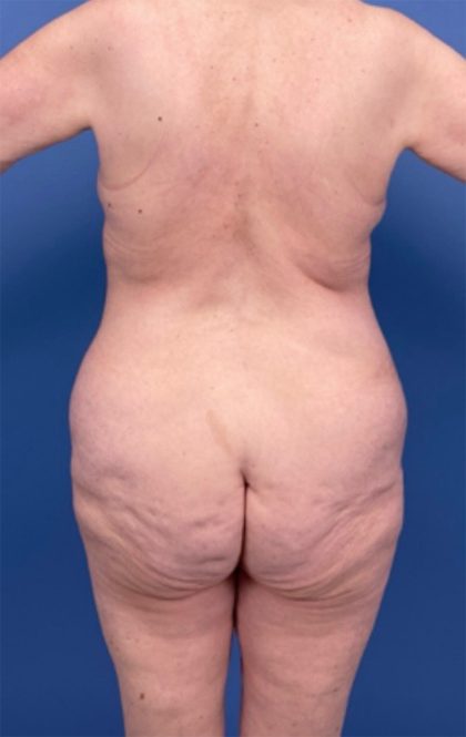 Surgery After Massive Weight Loss Before & After Patient #15924