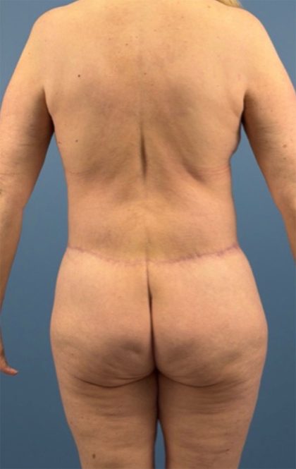 Surgery After Massive Weight Loss Before & After Patient #15924