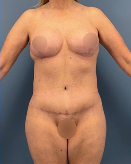 Surgery After Massive Weight Loss Before & After Patient #15924