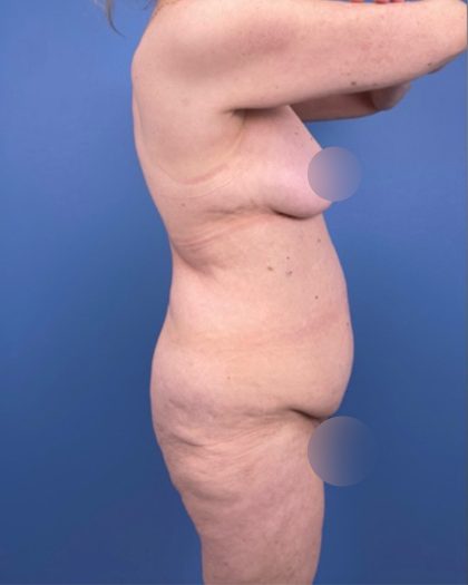 Surgery After Massive Weight Loss Before & After Patient #15924