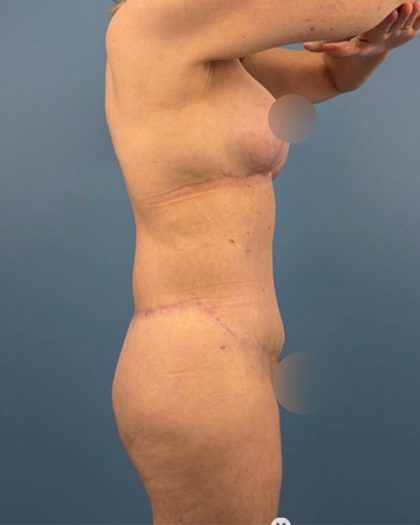 Surgery After Massive Weight Loss Before & After Patient #15924