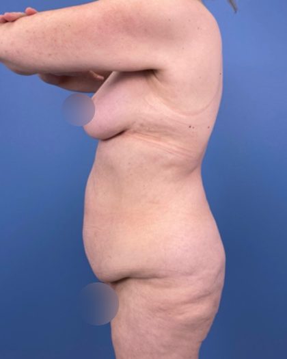 Surgery After Massive Weight Loss Before & After Patient #15924