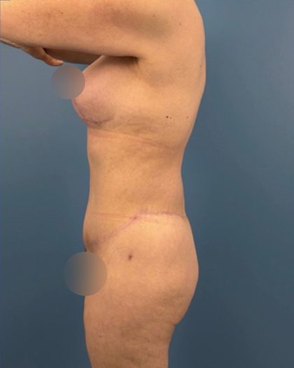 Surgery After Massive Weight Loss Before & After Patient #15924