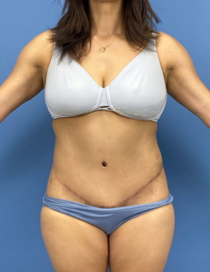 Lower Body Lift Before & After Patient #15802