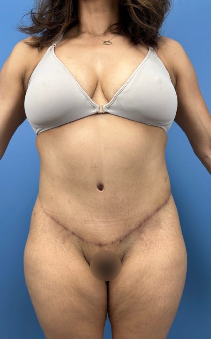 Lower Body Lift Before & After Patient #15802
