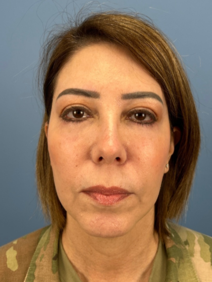 Facial Fat Grafting Before & After Patient #15857