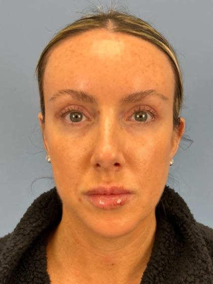 Browlift Before & After Patient #15868