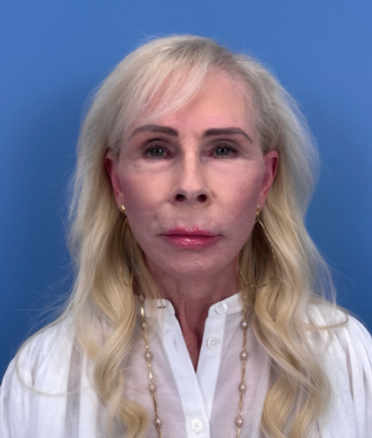 Facial Fat Grafting Before & After Patient #15993
