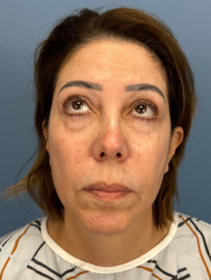 Facial Fat Grafting Before & After Patient #15857