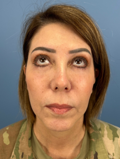 Facial Fat Grafting Before & After Patient #15857